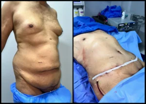 شد البطن قبل و بعد للرجال مع شد العانة