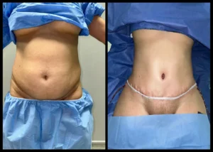 عملية شد البطن قبل و بعد