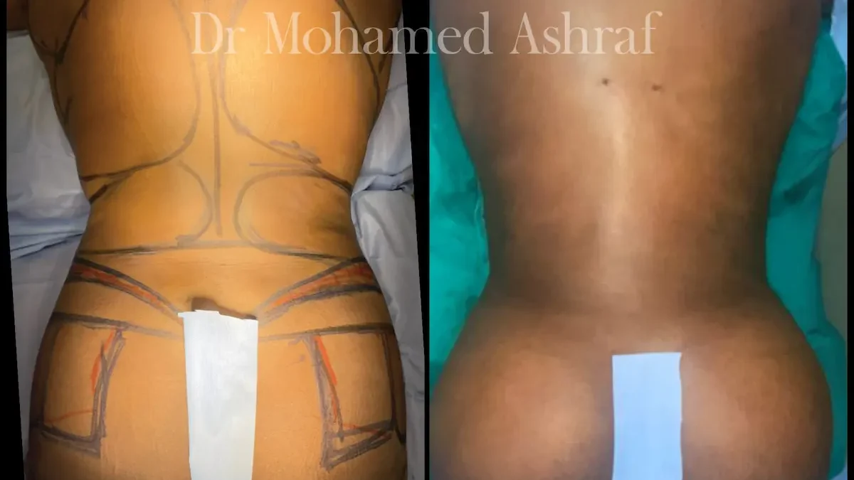 شفط دهون الظهر بالفيزر