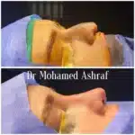 أشهر دكتور تجميل أنف في مصر