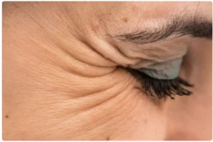 Botox-crows feet