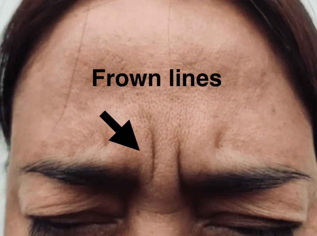 frown lines for botox