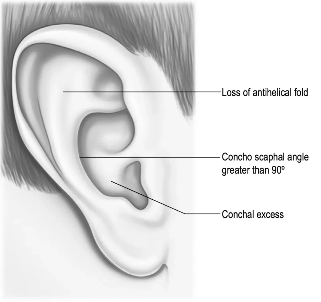 prominent ears - otoplasty