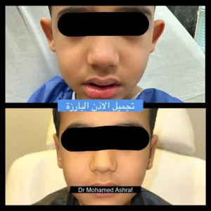 تجميل الاذن الخفاشية -الاذن البارزة