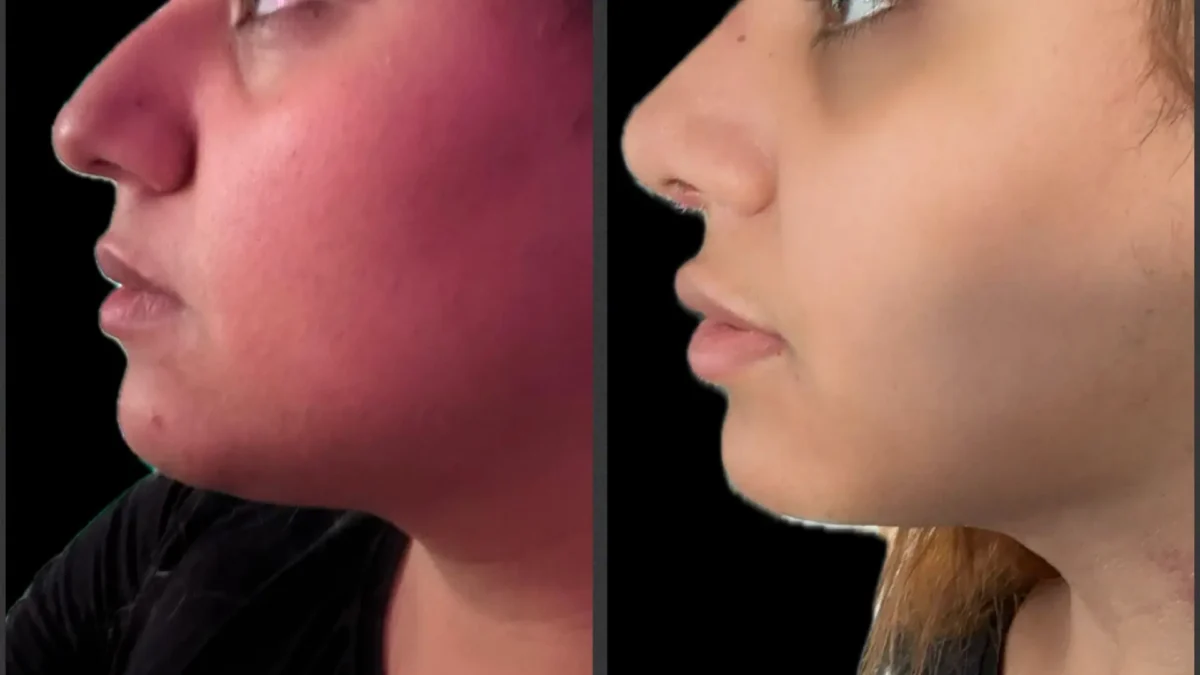 rhinoplasty