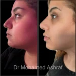 rhinoplasty