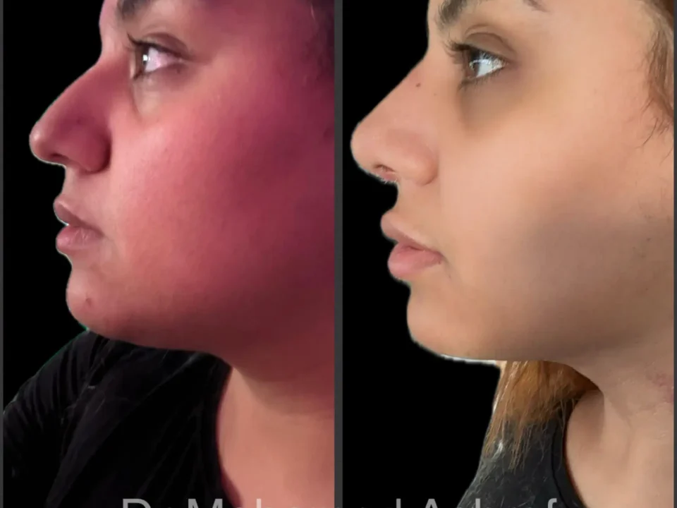 rhinoplasty