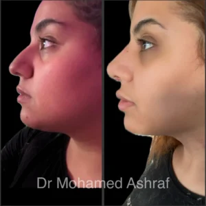 تجمل الانف
