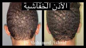 تجميل الاذن