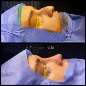 تجميل الانف