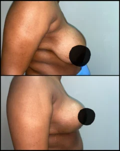breast reduction
