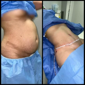 tummy tuck in Cairo