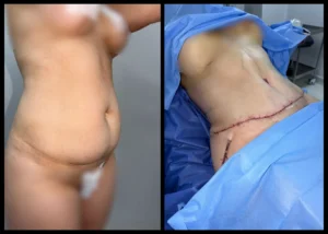 tummy tuck in Egypt